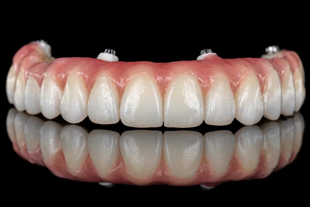 Restoration with Gingival Ceramic · Frontal View